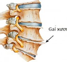 Thực hiện vật lý trị liệu bệnh gai cột sống thắt lưng như thế nào?