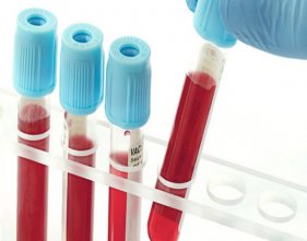 Xét nghiệm, Chẩn đoán tiền ung thư